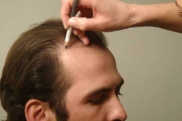 Affordable FUE Hair Transplant Options in Islamabad