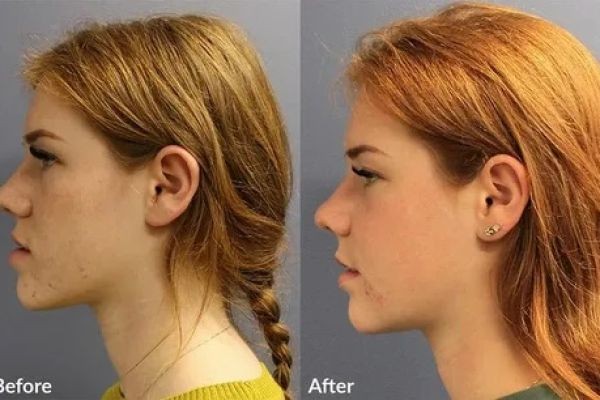 Jaw Surgery in Islamabad for Minimalist Aesthetic Changes: Subtle Yet Powerful Results