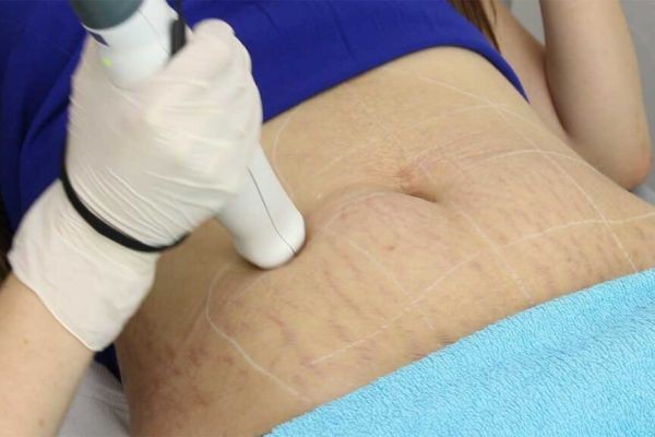 Is Laser Stretch Marks Treatment Safe for All Skin Types?