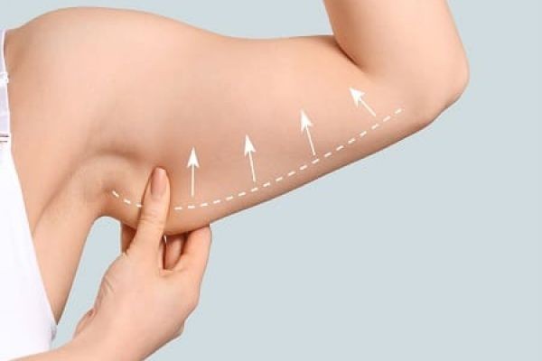 J Plasma Treatment for Arm Sagging Dubai | Advanced Skin Tightening for Firmer Arms