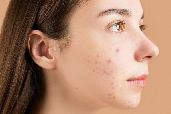 Laser Acne Treatment in Islamabad: Benefits and Risks