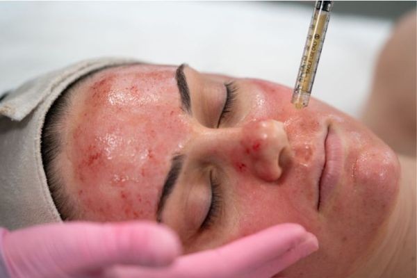 What Is Microneedling with PRP Therapy and How Does It Work?