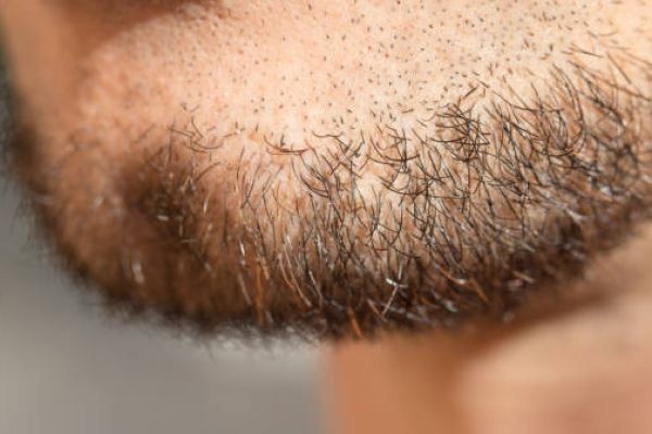 Beard Hair Transplant: Upgrade Your Look with a Fuller, Natural Beard