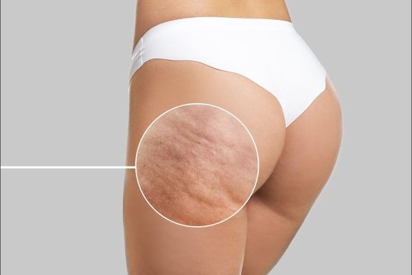 Cellulite Removal Tips for Women in Islamabad