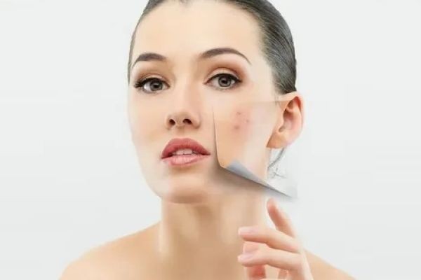 Acne Care Routines Recommended by Islamabad Dermatologists