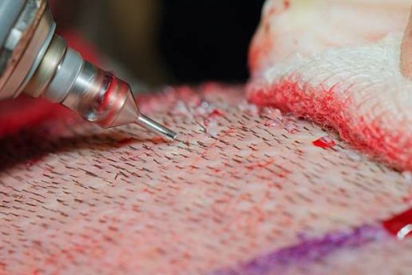 FUE Hair Transplant in Islamabad – A Modern Approach to Hair Restoration