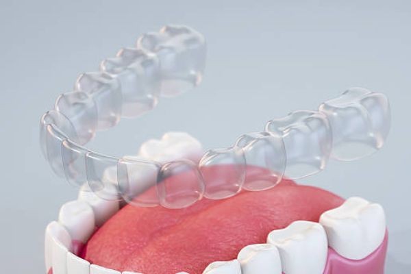 Premium Smile Alignment Experience with Teeth Aligners in Islamabad