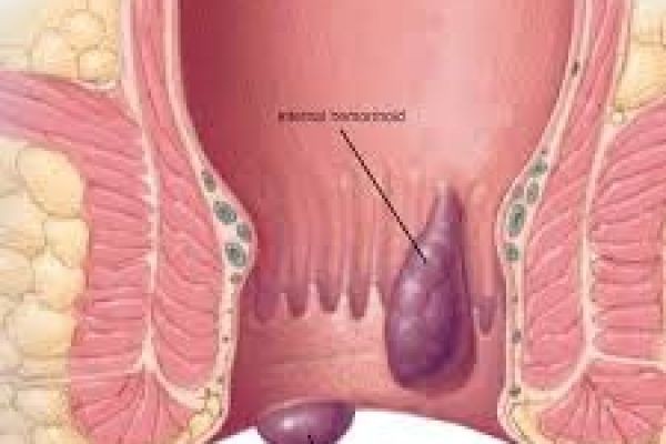 What to Expect During Haemorrhoids Treatment in Dubai | Complete Patient Guide