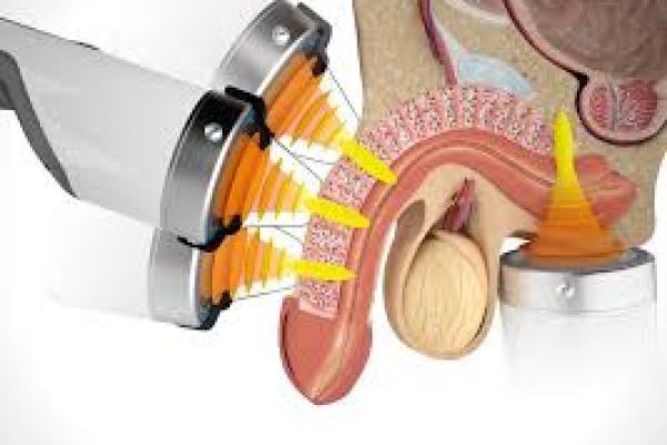 Why Men Prefer Professional Erectile Dysfunction Treatment in Dubai