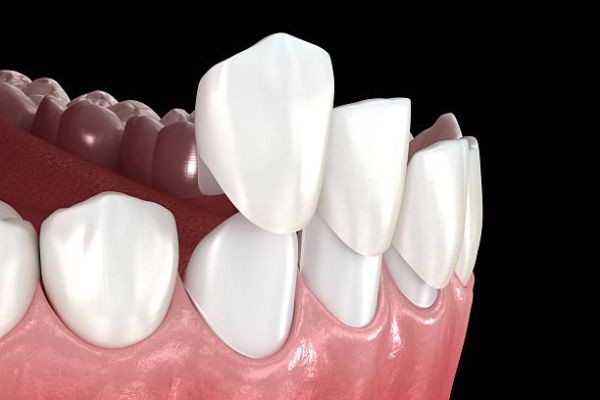 Dental Veneers in Pakistan: A Modern Smile Transformation Solution