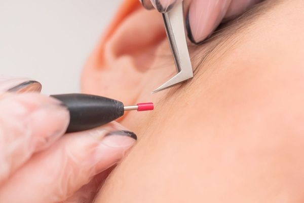 Electrolysis hair removal: Your Roadmap to Clearer Skin
