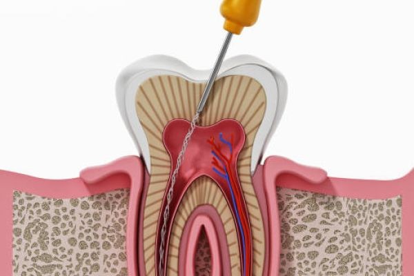 Root Canal Treatment in Pakistan – Protecting Your Smile Through Modern Dentistry