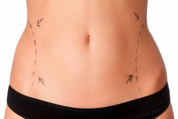 Liposuction in Dubai: Science-Backed Fat Reduction Results