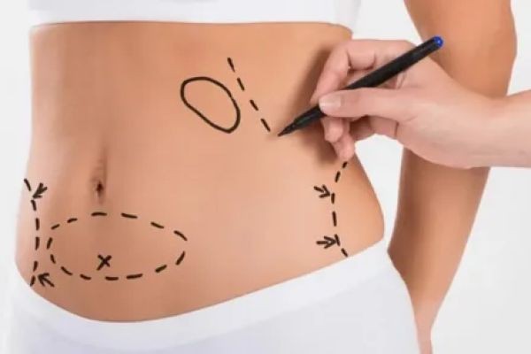 Best Tummy Tuck Dubai: Understanding Muscle Repair Techniques