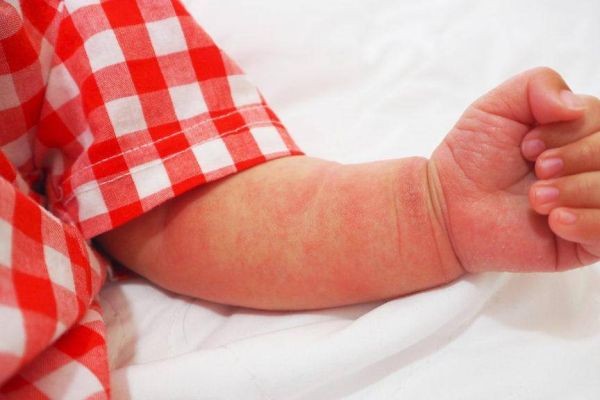 Atopic Dermatitis Market Challenges Reveal Critical Industry Bottlenecks Impacting Atopic Dermatitis Treatment
