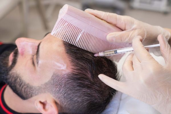 PRP Hair Treatment in Dubai: A Complete Guide to Natural Hair Recovery