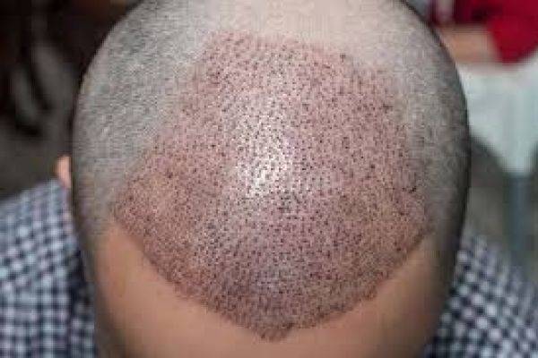 Hair Transplant in Abu Dhabi for Long-Lasting Hair Growth