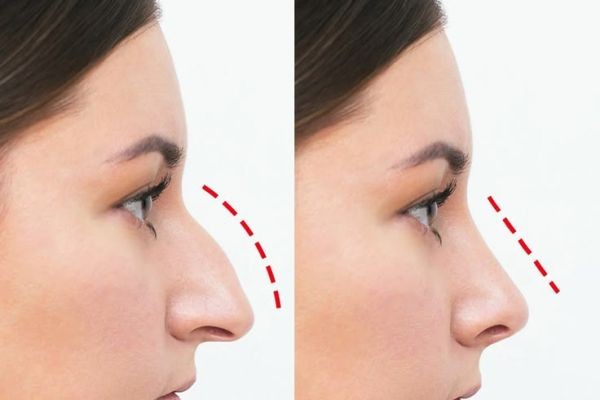 Rhinoplasty in Dubai: What to Expect During Care
