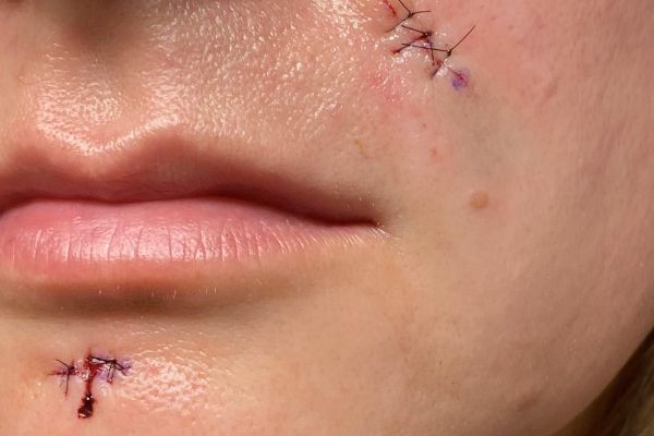 When to Watch Healing Suture Removal at Home in Dubai