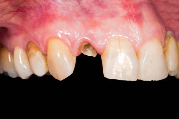 Reliable Tooth Repair Treatments for Damaged Teeth in Pakistan