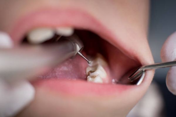 Dental Filling in Pakistan – Safe and Effective Treatment for Tooth Cavities