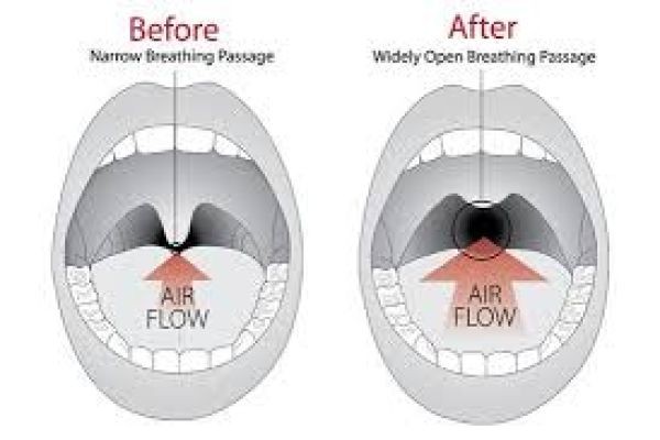 Snoring Treatment in Dubai for Lasting Results