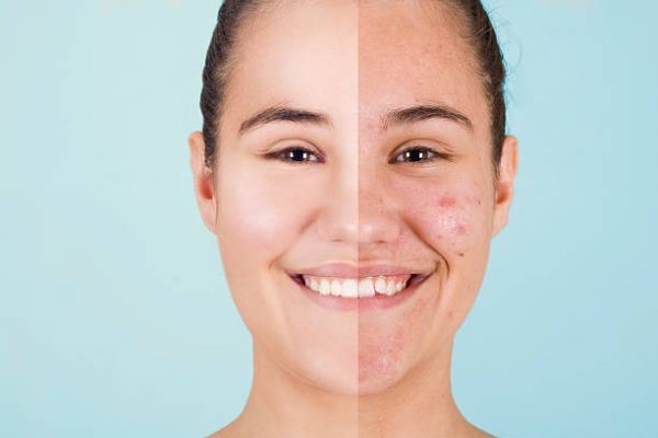 Acne Treatment In Islamabad: Modern Skincare Solutions for Men and Women