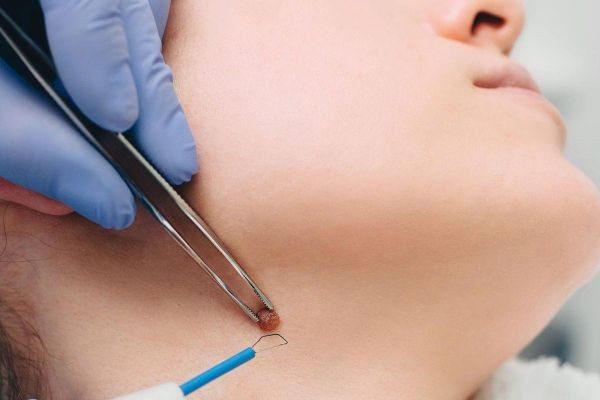 Mole Removal in Dubai: The Importance of Clinical Screening