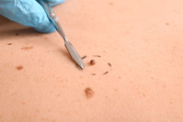Experience Smooth Results with Laser Wart Removal in Dubai for Clear Skin