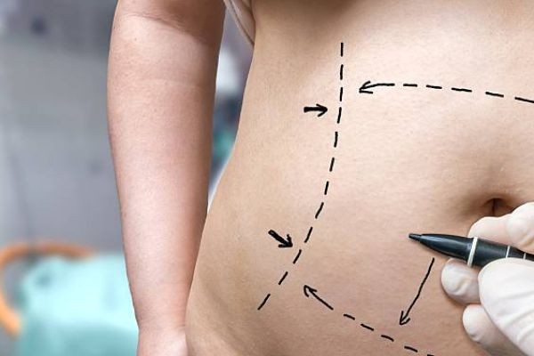 How Liposuction in Islamabad Helps You Achieve a Slimmer Figure Fast