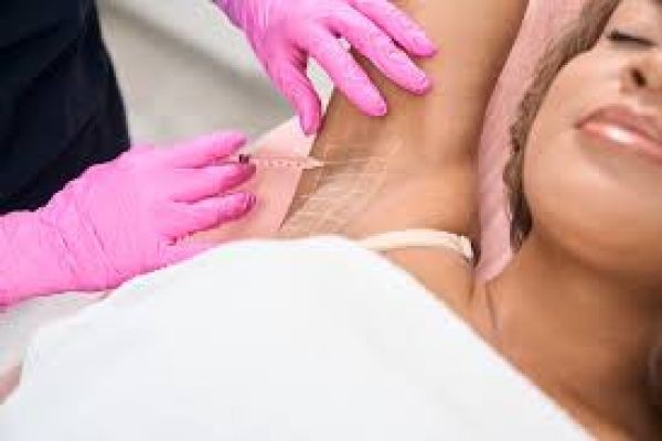 Non-Surgical Hyperhidrosis Treatment in Dubai for Effective Sweat Control
