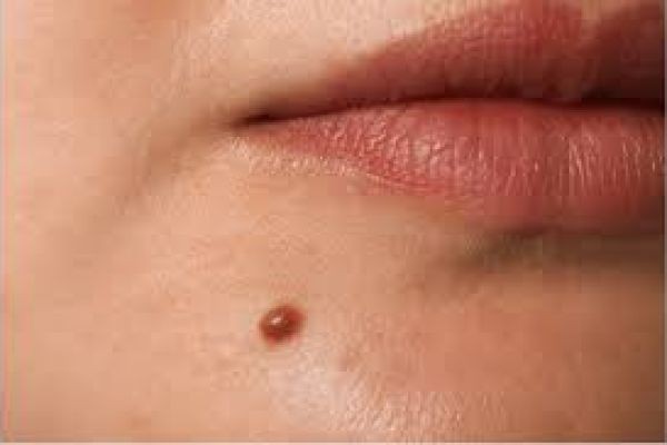 Benefits of Professional Mole Removal in Dubai: Safe Skin Solutions
