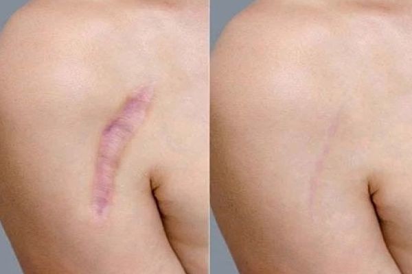 Best Time to Get Surgical Scar Revision for Optimal Results