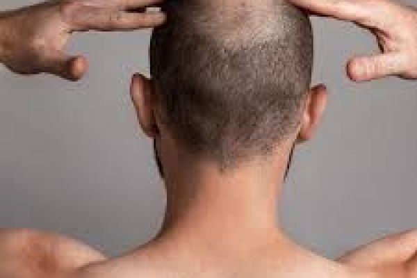 Common Myths About Hair Transplant Abu Dhabi Debunked