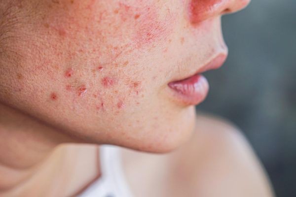 What Skin Types Need Pimples Treatment in Dubai?