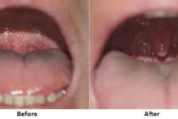 Snoring Treatment in Dubai: Causes, Risks, and Effective Solutions
