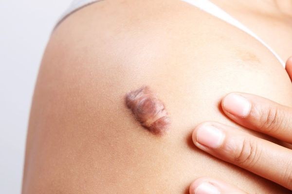 Keloid Treatment in Islamabad: How to Choose the Right Clinic