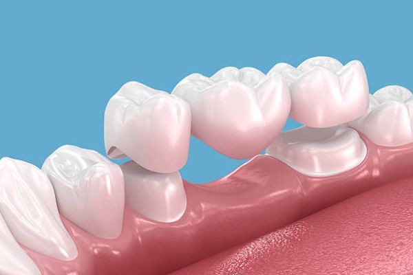 Dental Crowns: A Trusted Treatment for Long-Term Tooth Repair and Smile Restoration