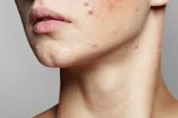 Scar Removal in Dubai for Acne, Injury, and Surgical Marks – Advanced Skin Renewal Solutions
