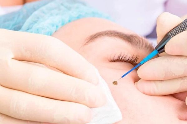 Wart Removal in Islamabad: Why More People Are Choosing Laser Treatment