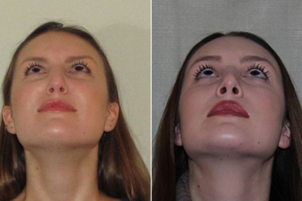 Septoplasty and Turbinate Reduction in Dubai: Nasal Relief
