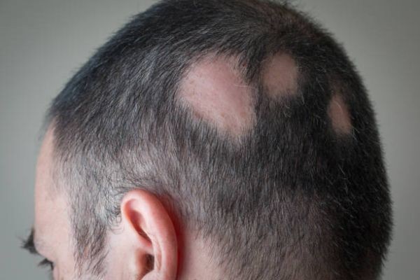Alopecia Areata Treatment in Andheri for Healthy Hair Regrowth - Adore Skin Clinic