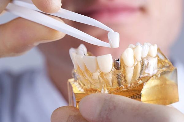 Dental Implants in Mumbai by Opal Dental
