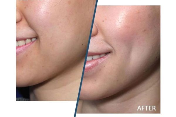 Smile Bright with Dimple Creation in Dubai