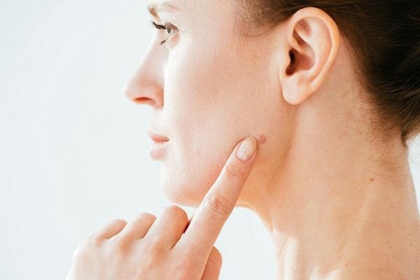 Can Mole Removal Improve Skin Confidence?