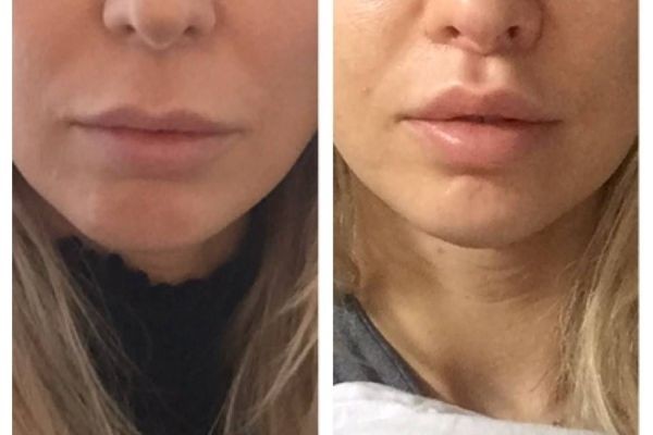 Volbella Fillers in Dubai: Revitalize Delicate Skin