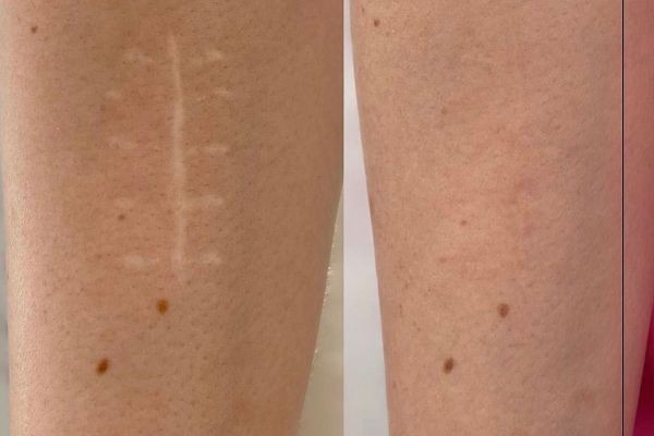 Scar removal in Dubai: Science-Backed Skin Restoration