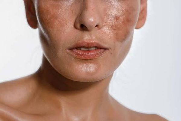 Is Melasma A Challenging Skin Condition?