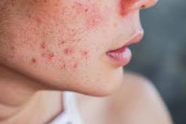 Best Skincare Plans with Pimple Treatment in Dubai for Clear and Healthy Skin
