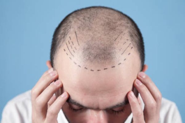 Hair Transplant in Dubai: Understanding FUE vs. FUT